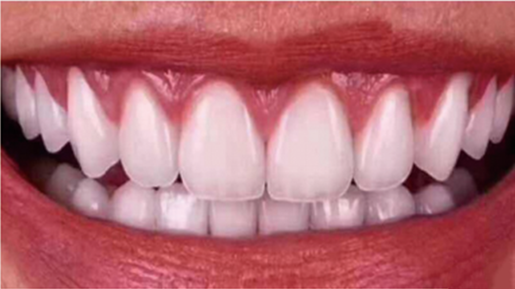 clinical-cases-of-prosthodorntics-bright-dental-lab